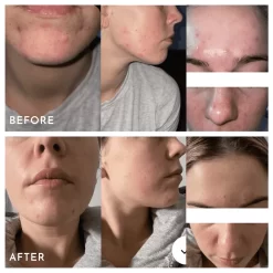 Aspect Extreme B 17 -Skin Care Store AspectExtremeB17BeforeAndAfters