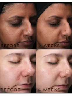 Medik8 Balance Moisturiser With Glycolic Acid Activator 14 Medik8 Balance Moisturiser With Glycolic Acid Activator -Skin Care Store Medik8BalanceMoisturiserWithGlycolicAcidActivatorBeforeAndAfter