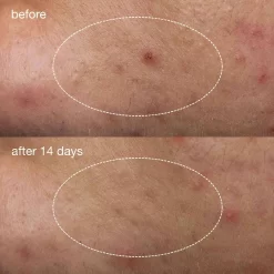 Dermalogica Deep Breakout Liquid Patch -Skin Care Store dermalogica deep acne liquid patches 1